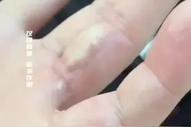 男子分享自己的痛苦经历，不是在被咬就是在被咬的路上，网友：下嘴没个轻重么视频封面