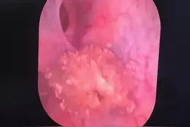 肾结石不痛了就万事大吉了吗？ #科普健康知识 #医学科普仅供参考如有不适请线下就医 #小荷健康问专家 #肾结石 #清石三件套 有时候肾结石发生绞痛也是好事，至少让你不会轻视它，今天又拯救一颗肾脏。