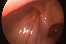你们想看的小儿疝气腹腔镜微创手术过程。常规探查对侧视频封面