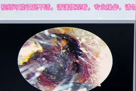 #可视采耳 #耳结石清理 #太久不掏耳朵会怎样 #海口采耳 #采耳视频封面