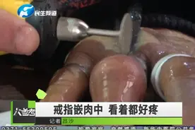 长时间配带戒指不取，导致戒指嵌入肉中，手指严重变形视频封面