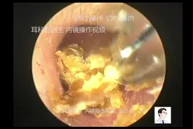 耳内镜清理片状真菌，11分钟视频封面