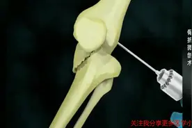 骨折微创手术的动画全过程，中国的医学技术迟早世界第一！视频封面