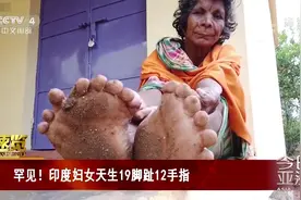 罕见！印度妇女天生19脚趾12手指视频封面