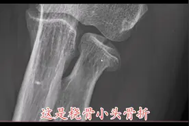 肘关节外伤之桡骨小头骨折，典型征象--“歪帽征” 你了解吗？视频封面