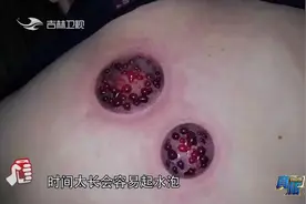 真相123：长期拔火罐是养生还是伤身？专家详细解答，以后要注意视频封面