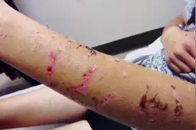 澳洲野狗疯狂攻击游客！小伙子浑身多处咬伤，爬上树才捡回一条命视频封面