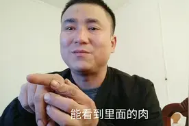 【好物分享】冬天手足开裂很疼，有一种乳膏用后很有效视频封面