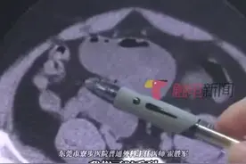 东莞男子连吃3根生香蕉致肠梗阻，医生：警惕食物未熟风险图片