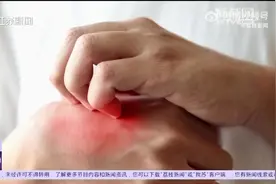 不建议在蚊子包上掐米字止痒，医生支招如何应对夏季皮肤瘙痒图片