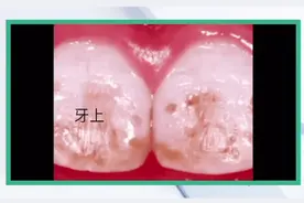 淄博口腔医院：牙上有洞有可能不是虫牙图片