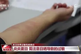 科普丨皮肤红肿、瘙痒？你可能“对太阳过敏”！防护指南快查收图片
