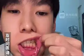 男子另辟蹊径对抗口腔溃疡 “让你知道谁才是身体的主人”图片