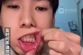 男子另辟蹊径对抗口腔溃疡 “让你知道谁才是身体的主人”图片