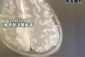 24岁小伙3颗烂牙2年没去治疗，淋雨后高烧就医，切除部分头骨后转危为安图片