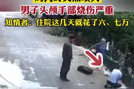 喷灯烤肉时火苗突然喷发，男子头颅手部烧伤严重图片