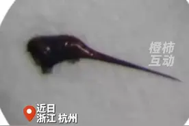 宝宝眼球被蜇进1根刺1个月才发现图片