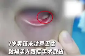 警惕！7岁男孩猫毛入眼后长肉芽手术取出图片