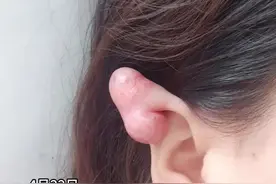 女子两年前打的耳洞，孕后增生，十块钱的耳洞，一两万的手术费，"得去整形外科做手术"图片