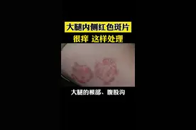 大腿内侧起红斑 瘙痒,别多想哈，这是股癣，可以这样处理#股癣 #健康科普 #医学科普#科普 视频封面