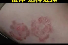 大腿内侧起红斑 瘙痒,别多想哈，这是股癣，可以这样处理#股癣 #健康科普 #医学科普#科普 视频封面